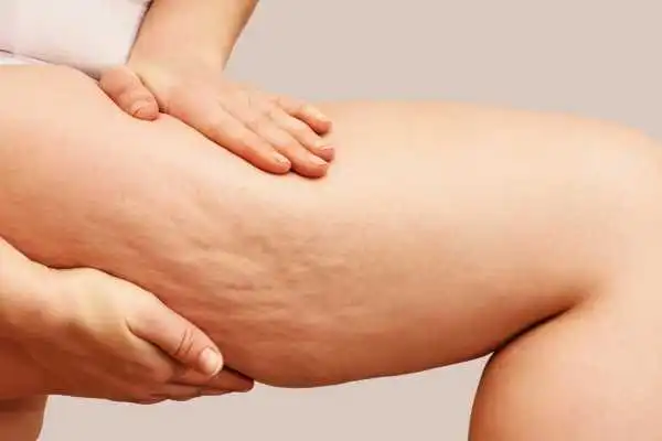 Image of woman showing leg with cellulite Crewe