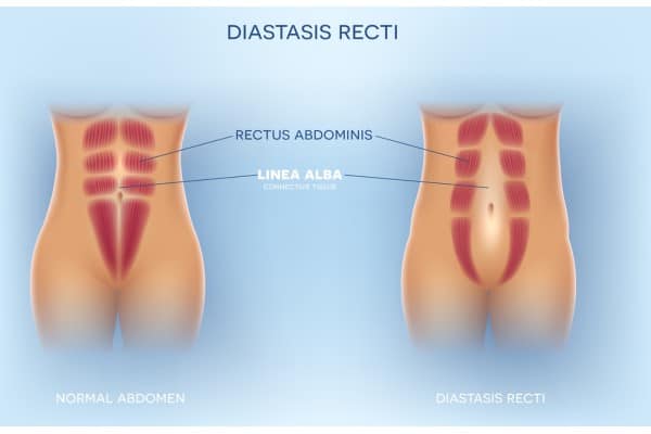 What Non-Surgical Options Are Available for Diastasis Recti Crewe?