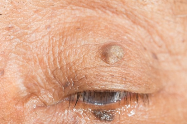 Skin imperfections Crewe - Cryopen is fast and effective book in today!