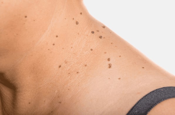 Are you looking for easy skin tag removal Crewe - then contact Spire today!