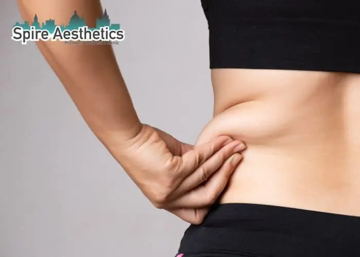 Image of woman pinching fat on their hips Crewe. Fat Freezing treatment 