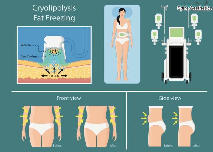 Image of diet and fat freezing combined for best results for Spire Aesthetics Crewe