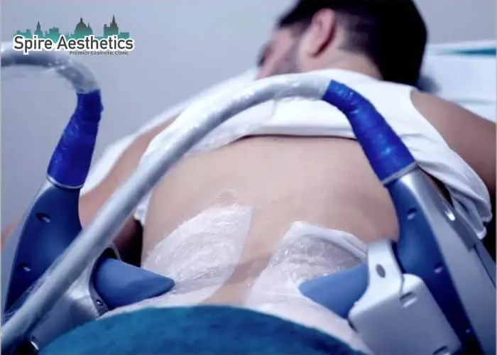Man having fat freezing treatment done on love handles before a competitions Crewe to create a sculpted look.