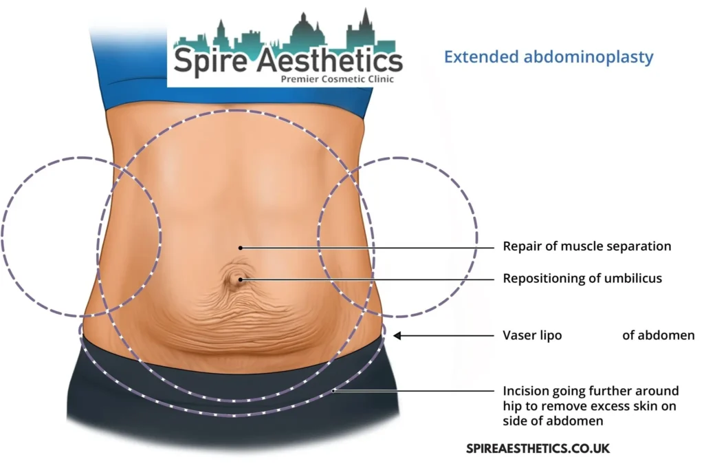 Understanding Loose Skin After Gastric Band Crewe Surgery and HIFU Treatment 