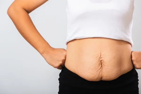 Image of a woman's stomach after weight loss with sagging skin following a gastric band Crewe