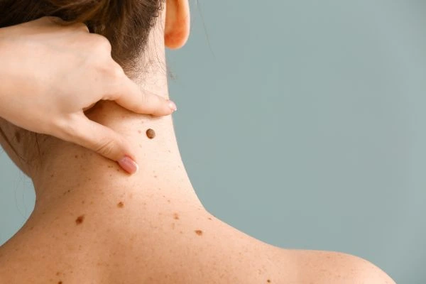 skin blemish removal Crewe treatment