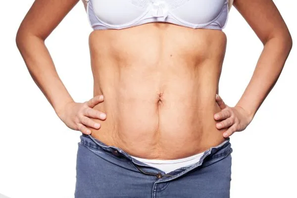 sagging skin on woman's stomach after weight loss injections Crewe