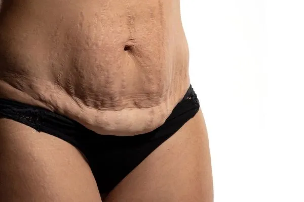 Image of womans stomach after weight loss injections Crewe showing saggy skin