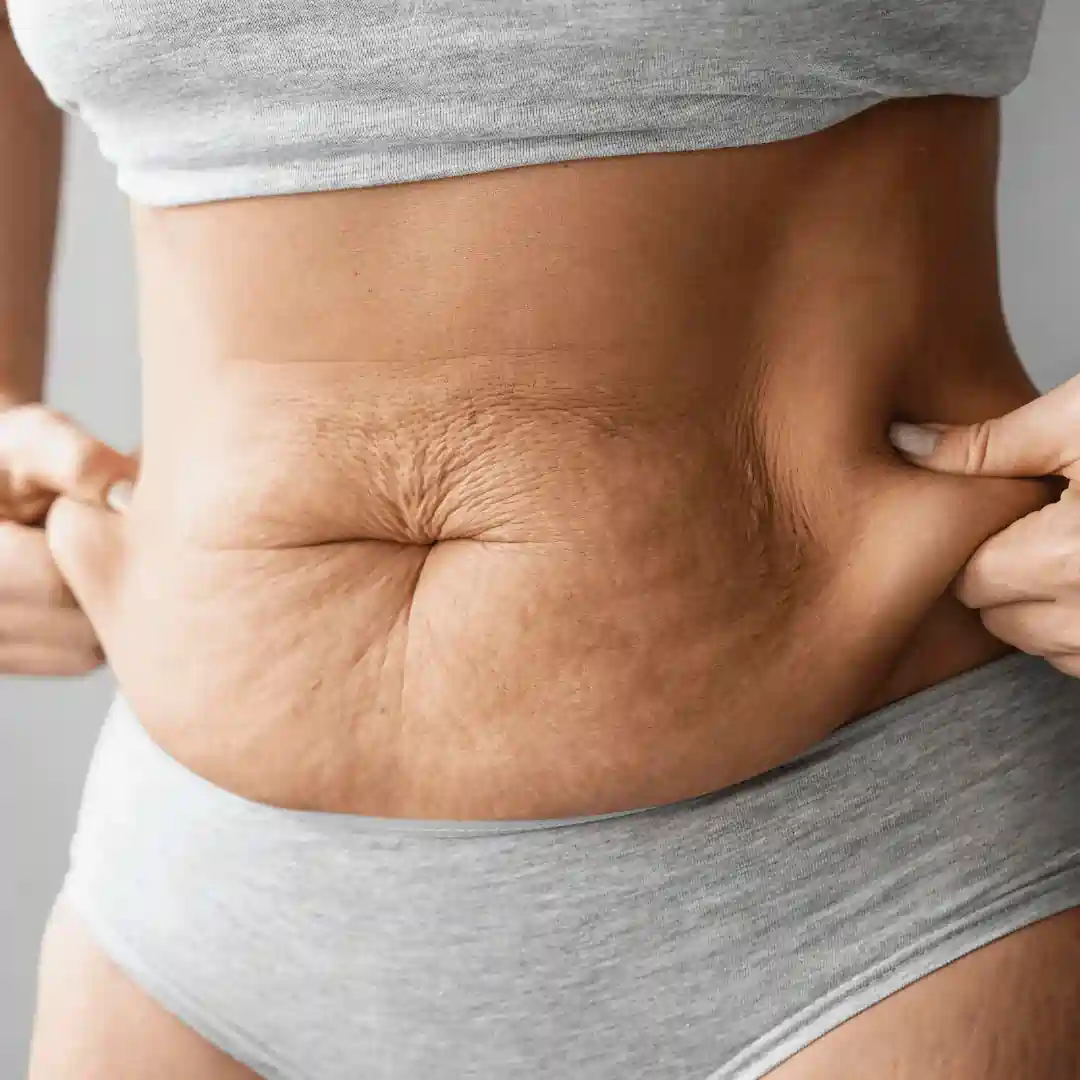 Is It Normal to Have Loose Skin After Pregnancy Crewe?