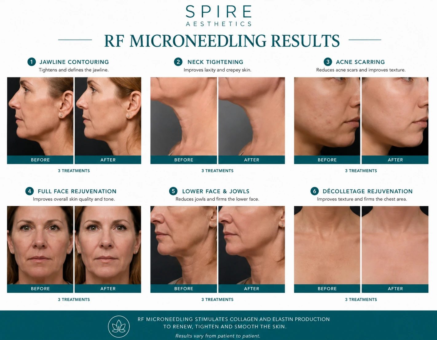 RF Microneedling Skin tightening Crewe results
