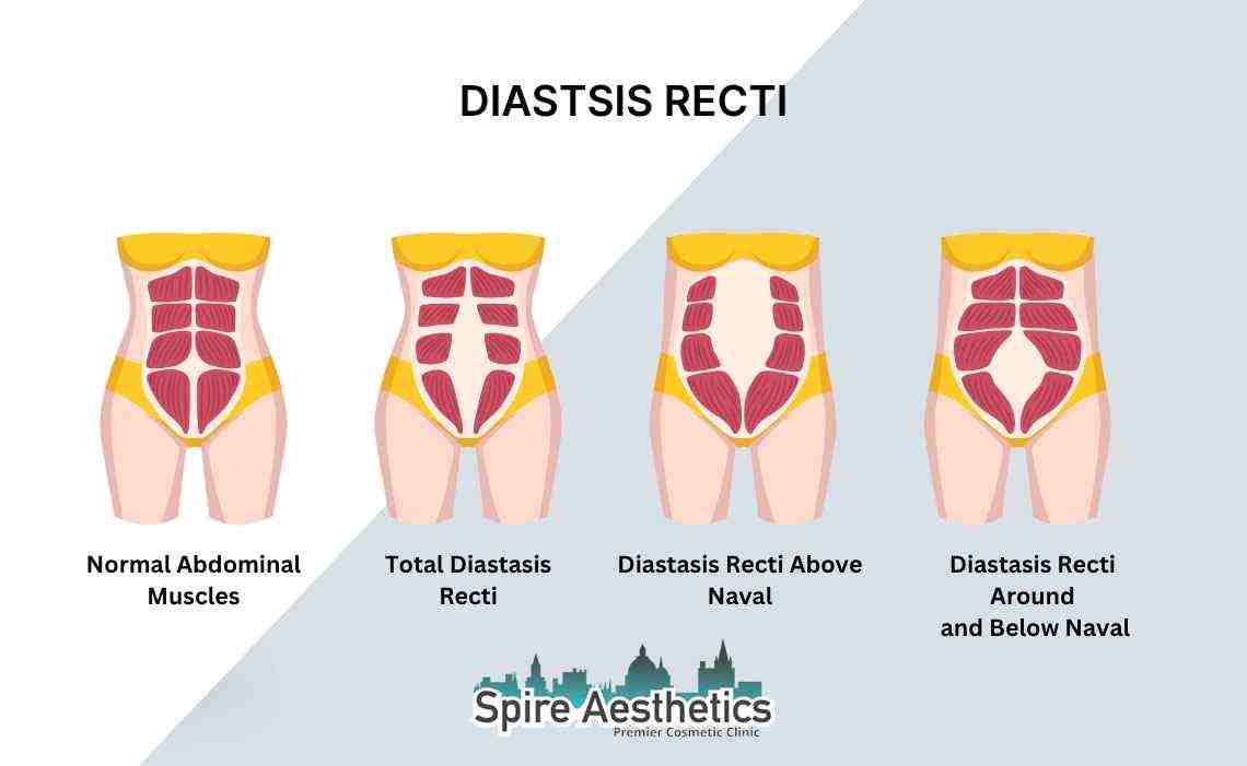 Is Non-Surgical Diastasis Recti Treatment Right for You? Common Concerns Answered Crewe